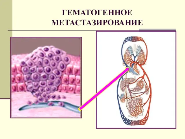 ГЕМАТОГЕННОЕ МЕТАСТАЗИРОВАНИЕ