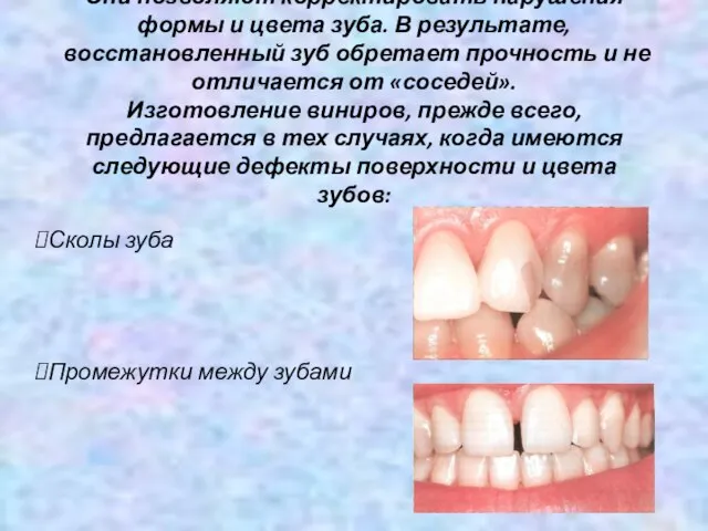 Они позволяют корректировать нарушения формы и цвета зуба. В результате, восстановленный зуб