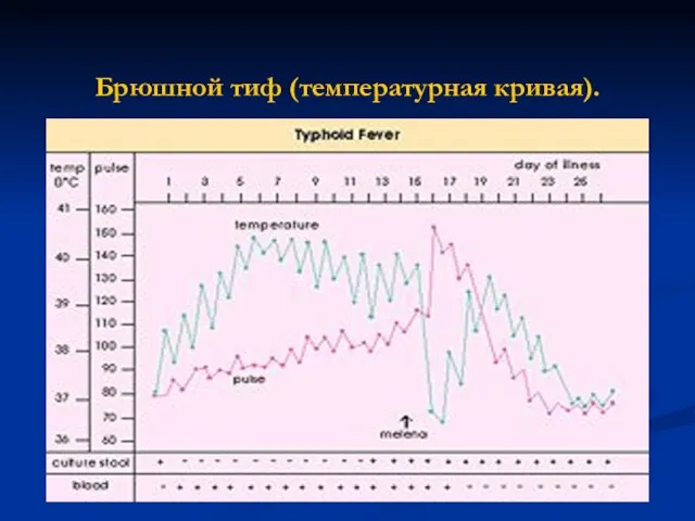 Брюшной тиф (температурная кривая).