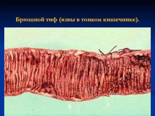 Брюшной тиф (язвы в тонком кишечнике).