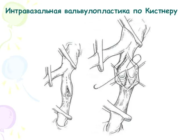 Интравазальная вальвулопластика по Кистнеру