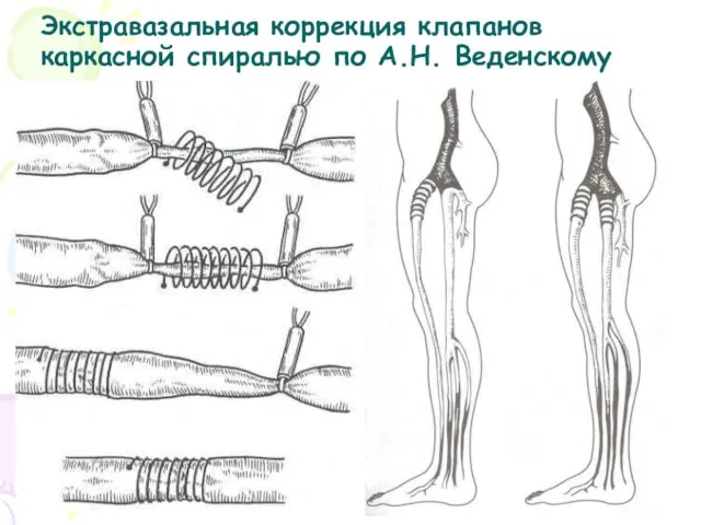 Экстравазальная коррекция клапанов каркасной спиралью по А.Н. Веденскому