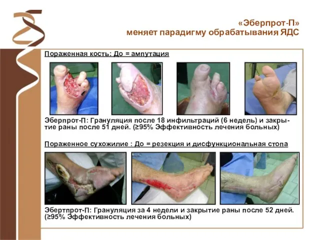 Пораженная кость: До = ампутация Эбертпрот-П: Грануляция за 4 недели и закрытие