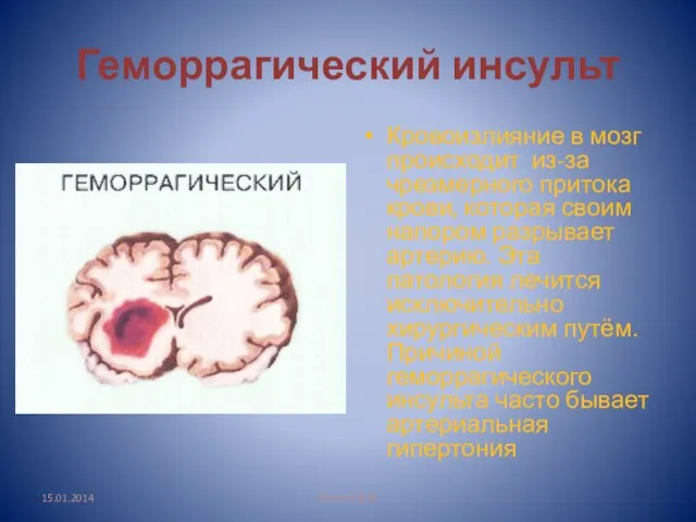 Геморрагический инсульт Кровоизлияние в мозг происходит из-за чрезмерного притока крови, которая своим