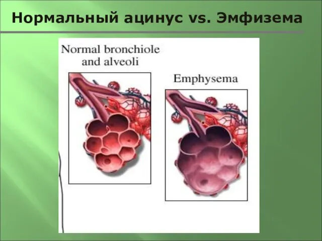 Нормальный ацинус vs. Эмфизема