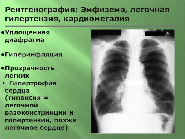 Рентгенография: Эмфизема, легочная гипертензия, кардиомегалия Уплощенная диафрагма Гиперинфляция Прозрачность легких Гипертрофия сердца