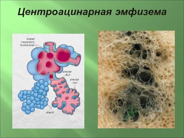 Центроацинарная эмфизема