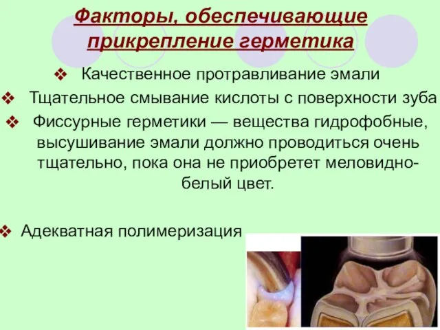 Факторы, обеспечивающие прикрепление герметика Качественное протравливание эмали Тщательное смывание кислоты с поверхности