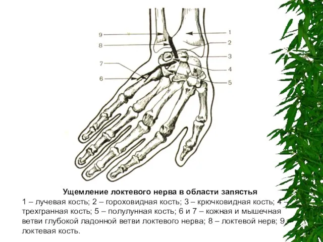 Ущемление локтевого нерва в области запястья 1 – лучевая кость; 2 –