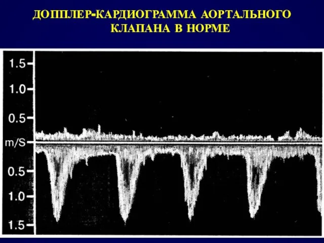 ДОППЛЕР-КАРДИОГРАММА АОРТАЛЬНОГО КЛАПАНА В НОРМЕ