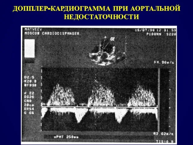 ДОППЛЕР-КАРДИОГРАММА ПРИ АОРТАЛЬНОЙ НЕДОСТАТОЧНОСТИ