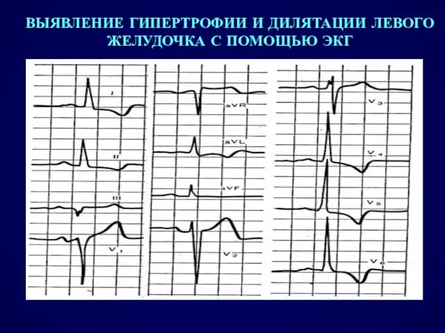 ВЫЯВЛЕНИЕ ГИПЕРТРОФИИ И ДИЛЯТАЦИИ ЛЕВОГО ЖЕЛУДОЧКА С ПОМОЩЬЮ ЭКГ