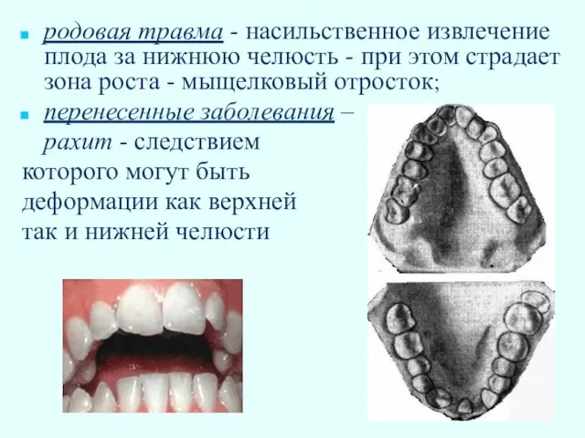 родовая травма - насильственное извлечение плода за нижнюю челюсть - при этом