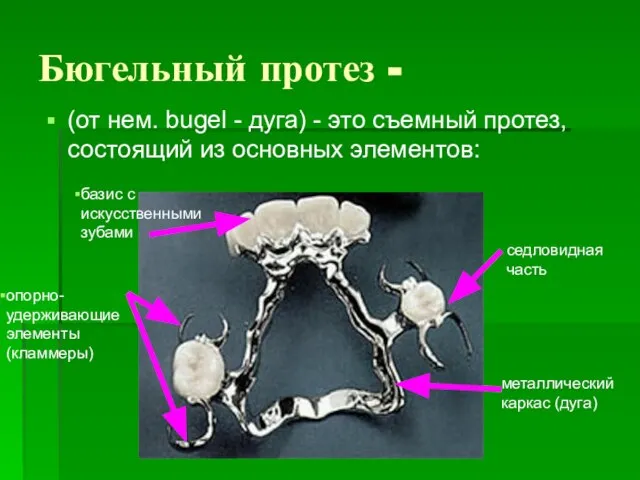 Бюгельный протез - (от нем. bugel - дуга) - это съемный протез,