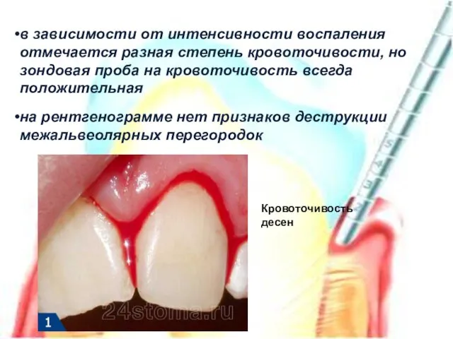 в зависимости от интенсивности воспаления отмечается разная степень кровоточивости, но зондовая проба