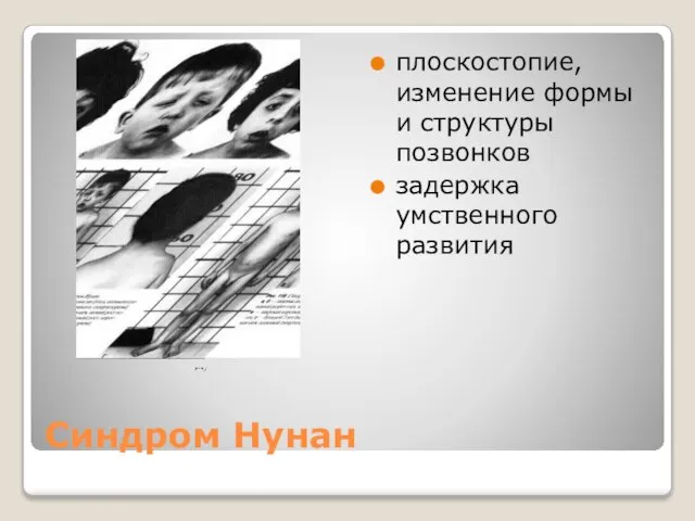 Синдром Нунан плоскостопие, изменение формы и структуры позвонков задержка умственного развития