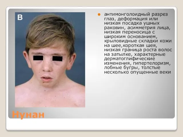 Нунан антимонголоидный разрез глаз, деформация или низкая посадка ушных раковин, асимметрия лица,
