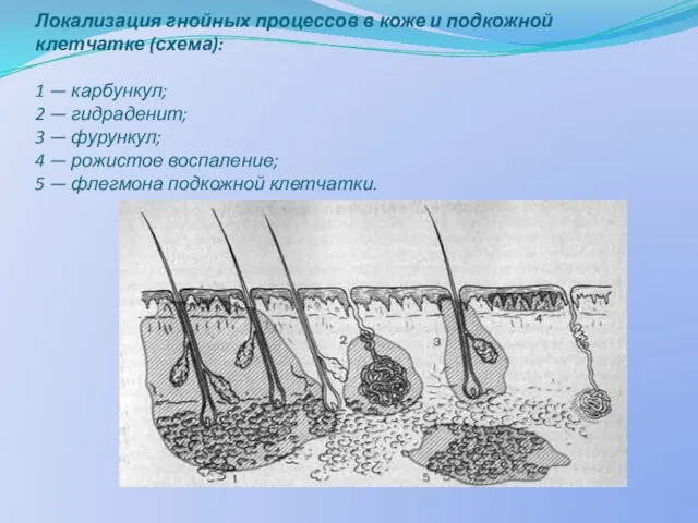 Локализация гнойных процессов в коже и подкожной клетчатке (схема): 1 — карбункул;