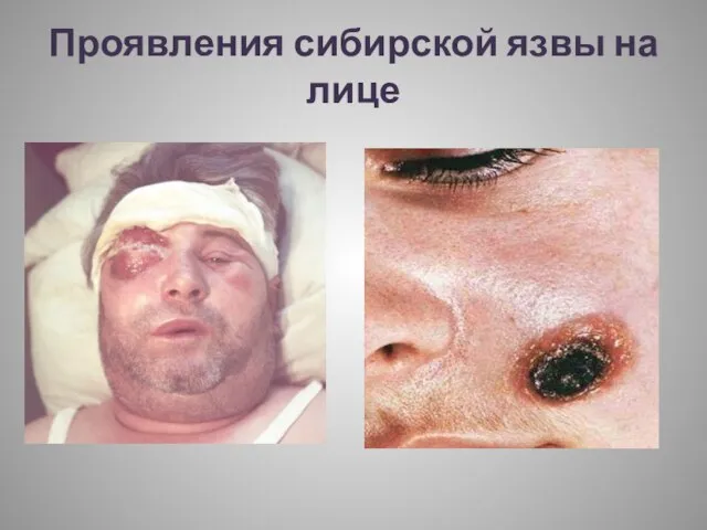 Проявления сибирской язвы на лице