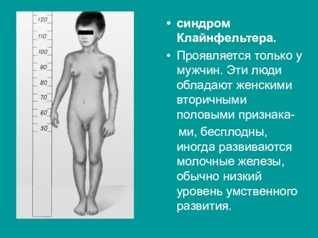 синдром Клайнфельтера. Проявляется только у мужчин. Эти люди обладают женскими вторичными половыми