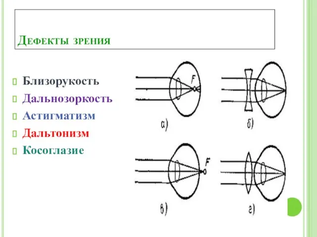 Дефекты зрения Близорукость Дальнозоркость Астигматизм Дальтонизм Косоглазие