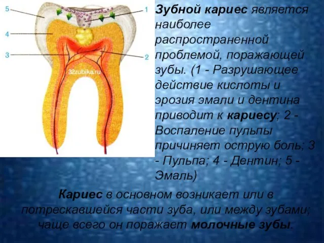 Кариес в основном возникает или в потрескавшейся части зуба, или между зубами;