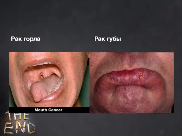 Рак горла Рак губы