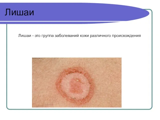 Лишаи Лишаи - это группа заболеваний кожи различного происхождения