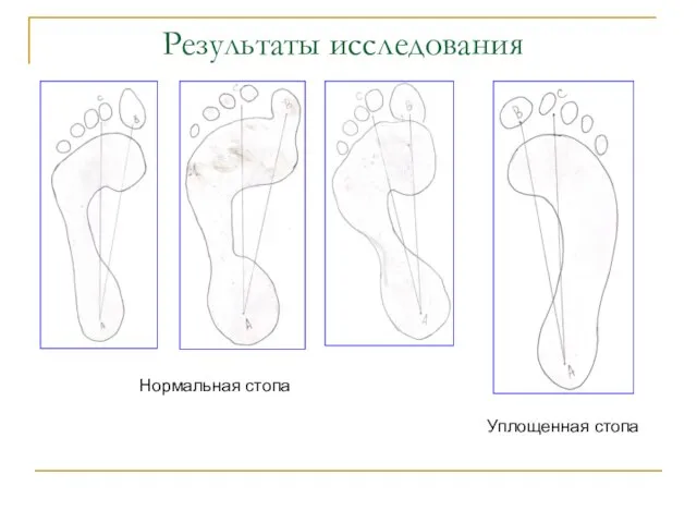 Результаты исследования Нормальная стопа Уплощенная стопа