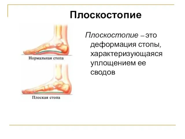 Плоскостопие – это деформация стопы, характеризующаяся уплощением ее сводов Плоскостопие