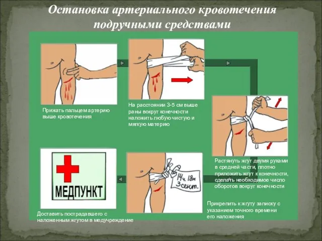 Остановка артериального кровотечения подручными средствами Прижать пальцем артерию выше кровотечения На расстоянии