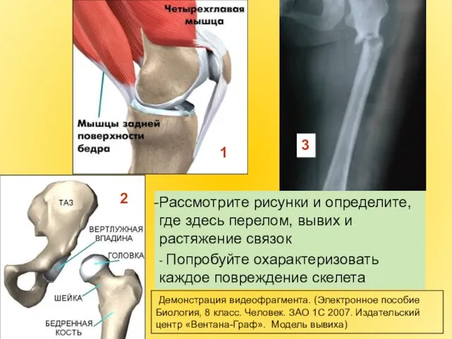 1 2 Рассмотрите рисунки и определите, где здесь перелом, вывих и растяжение