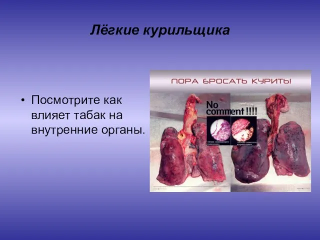 Лёгкие курильщика Посмотрите как влияет табак на внутренние органы.