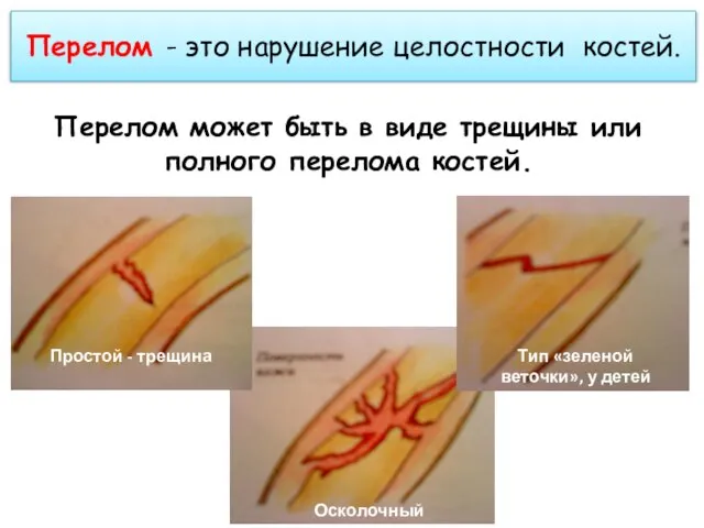 Перелом - это нарушение целостности костей. Перелом может быть в виде трещины