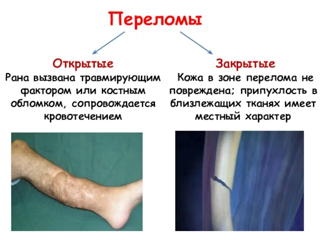 Открытые Рана вызвана травмирующим фактором или костным обломком, сопровождается кровотечением Закрытые Кожа