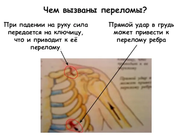 Чем вызваны переломы? При падении на руку сила передается на ключицу, что