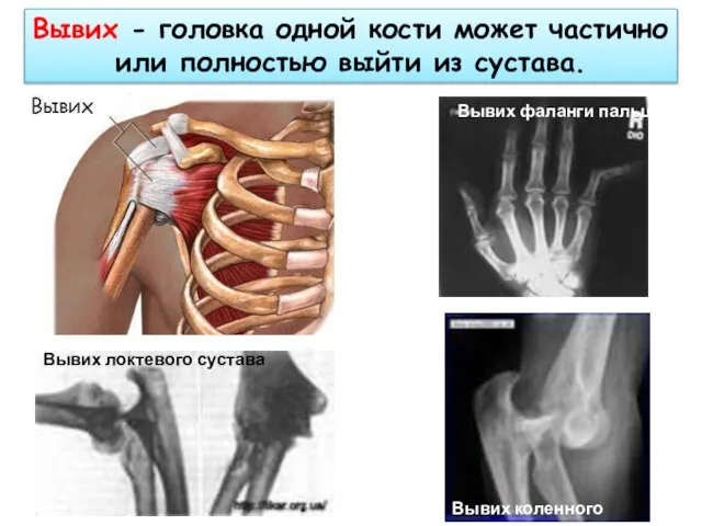 Вывих - головка одной кости может частично или полностью выйти из сустава.