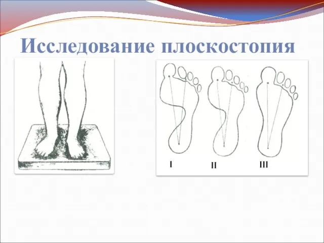 Исследование плоскостопия