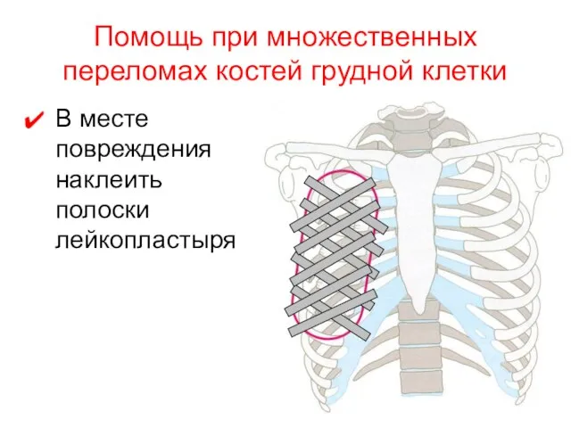 Помощь при множественных переломах костей грудной клетки В месте повреждения наклеить полоски лейкопластыря