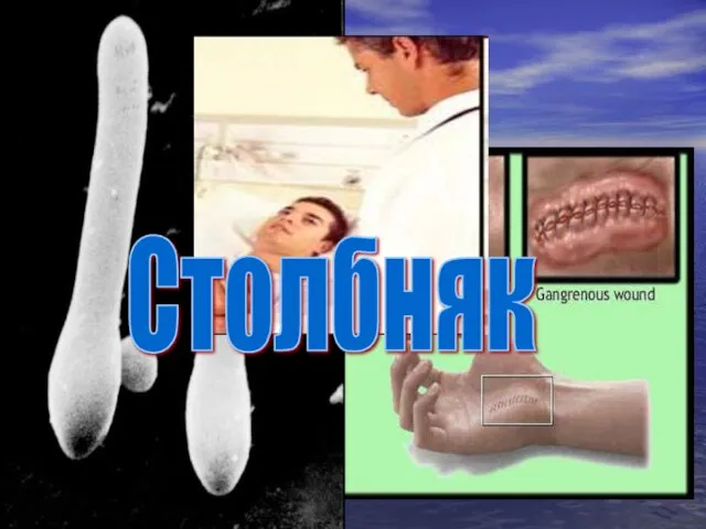 Столбняк