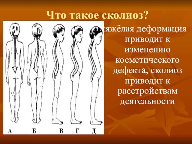 Что такое сколиоз? тяжёлая деформация приводит к изменению косметического дефекта, сколиоз приводит к расстройствам деятельности .