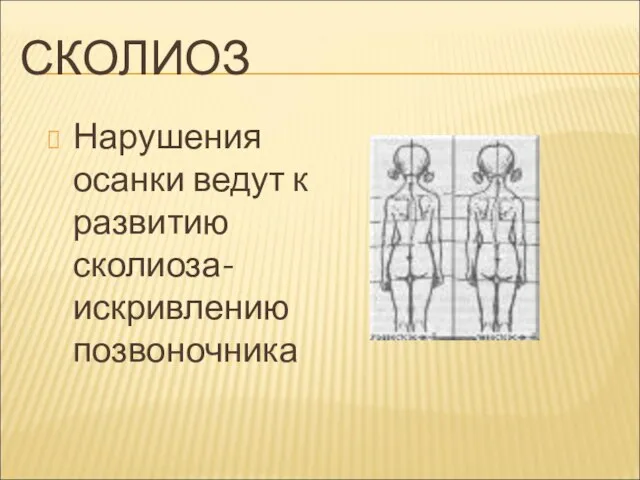 СКОЛИОЗ Нарушения осанки ведут к развитию сколиоза-искривлению позвоночника