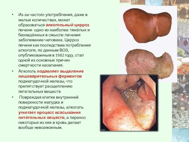 Из-за частого употребления, даже в малых количествах, может образоваться алкогольный цирроз печени-