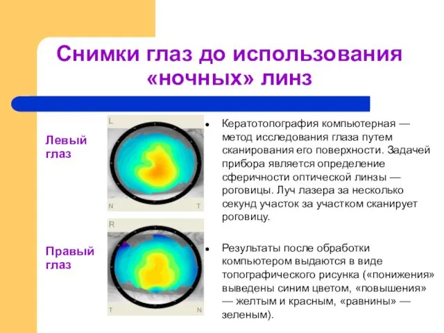 Снимки глаз до использования «ночных» линз Кератотопография компьютерная — метод исследования глаза