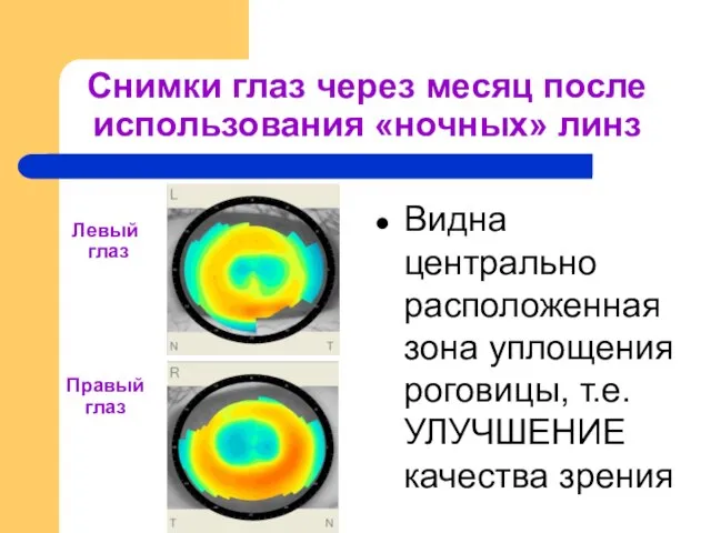 Снимки глаз через месяц после использования «ночных» линз Видна центрально расположенная зона