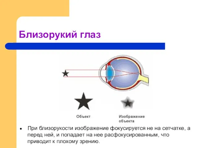 Близорукий глаз При близорукости изображение фокусируется не на сетчатке, а перед ней,