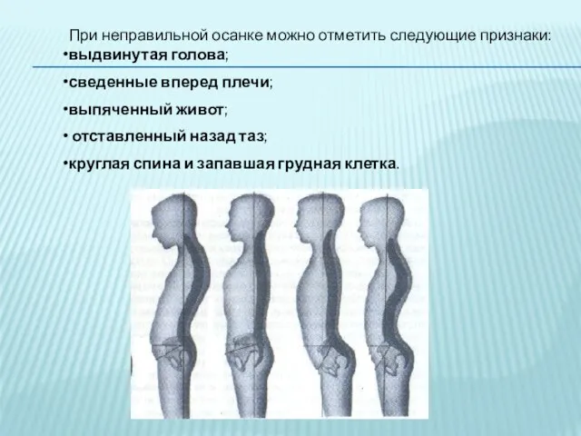 При неправильной осанке можно отметить следующие признаки: выдвинутая голова; сведенные вперед плечи;