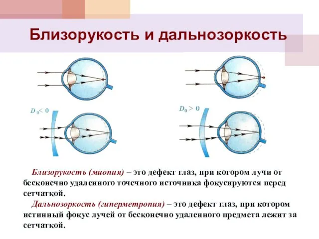 Близорукость и дальнозоркость Близорукость (миопия) – это дефект глаз, при котором лучи