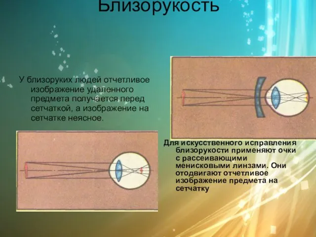 Близорукость У близоруких людей отчетливое изображение удаленного предмета получается перед сетчаткой, а