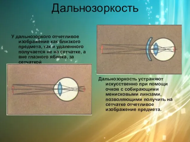 Дальнозоркость У дальнозоркого отчетливое изображение как близкого предмета, так и удаленного получается